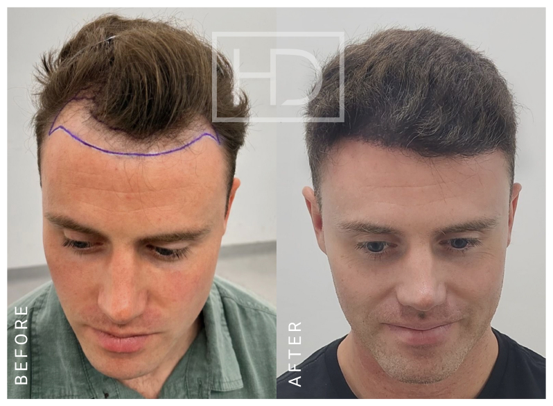 Nurse Hair Transplant Before & After