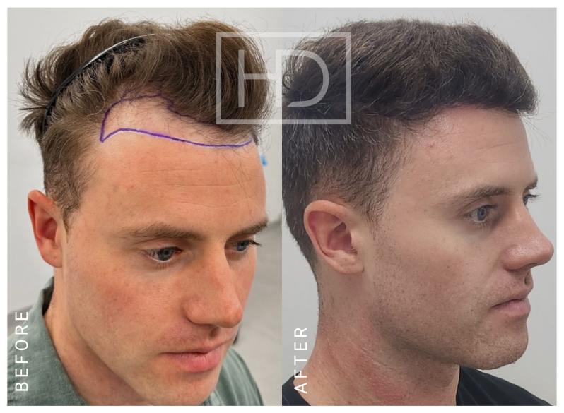 Nurse Hair Transplant Before & After
