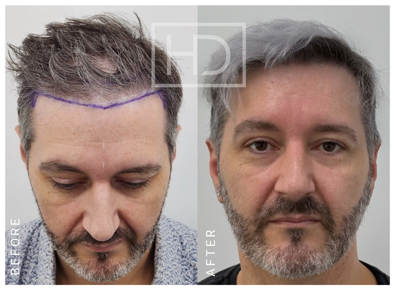 Nurse Hair Transplant Before & After