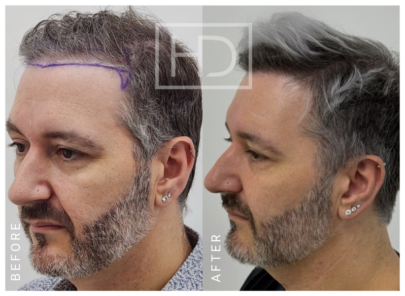 Nurse Hair Transplant Before & After