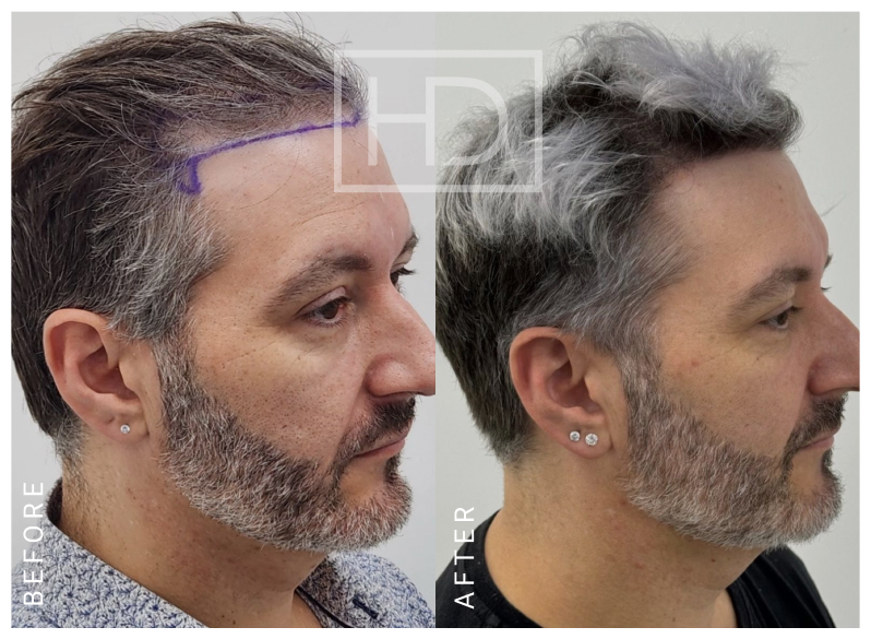 Nurse Hair Transplant Before & After
