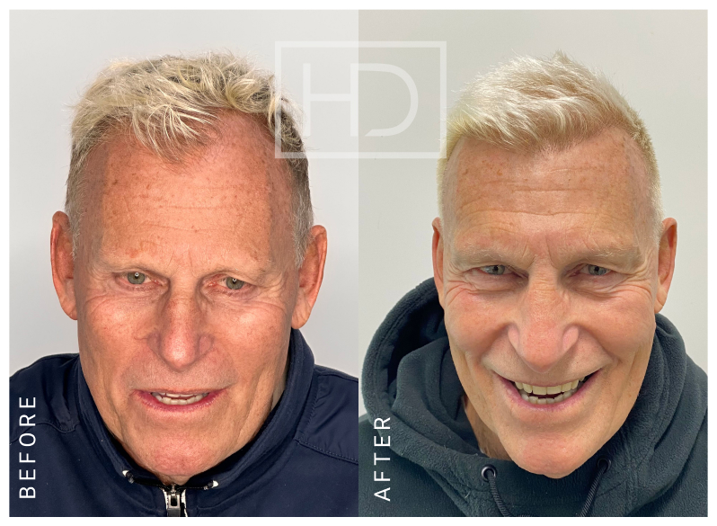 Nurse Hair Transplant Before & After