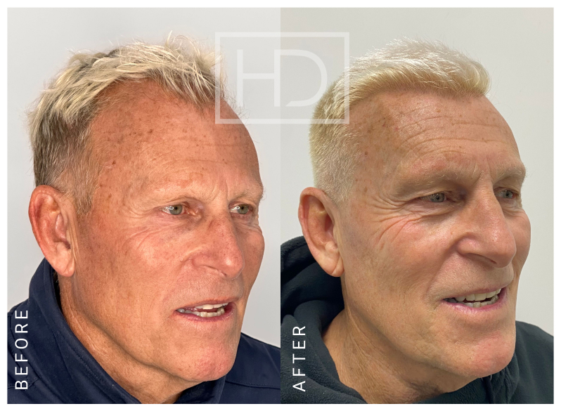 Nurse Hair Transplant Before & After Image