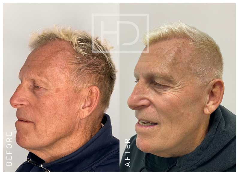 Nurse Hair Transplant Before & After Image