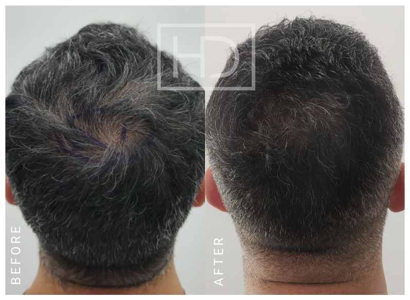 Nurse Hair Transplant Before & After
