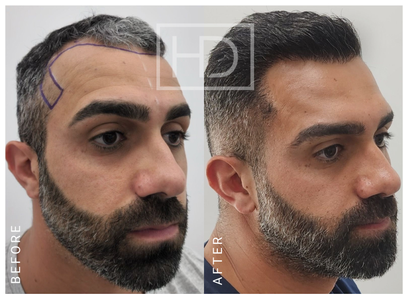Nurse Hair Transplant Before & After