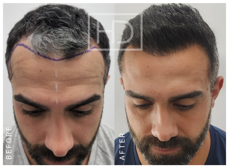 Hair Transplant Before & After Image