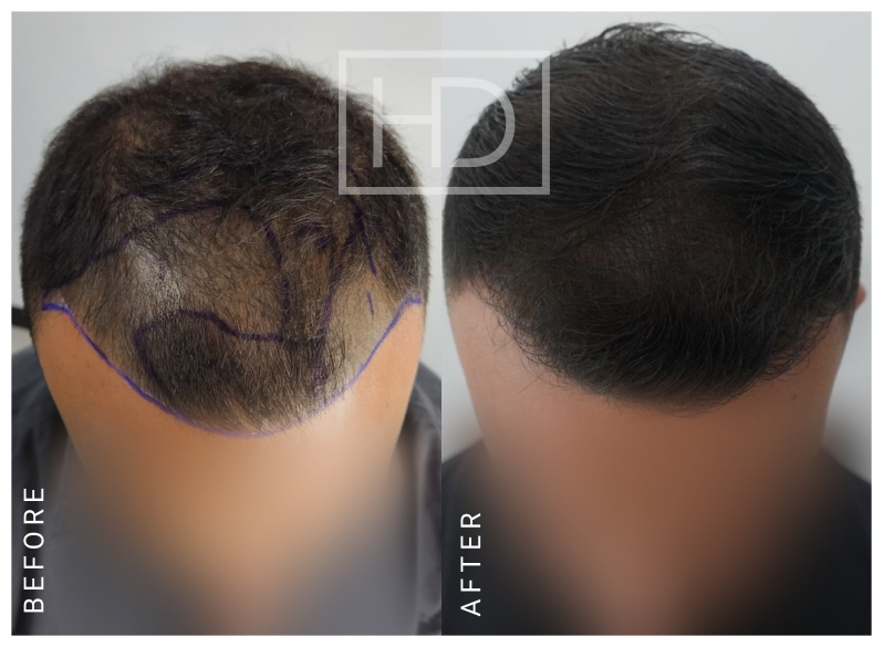 Doctor Hair Transplant