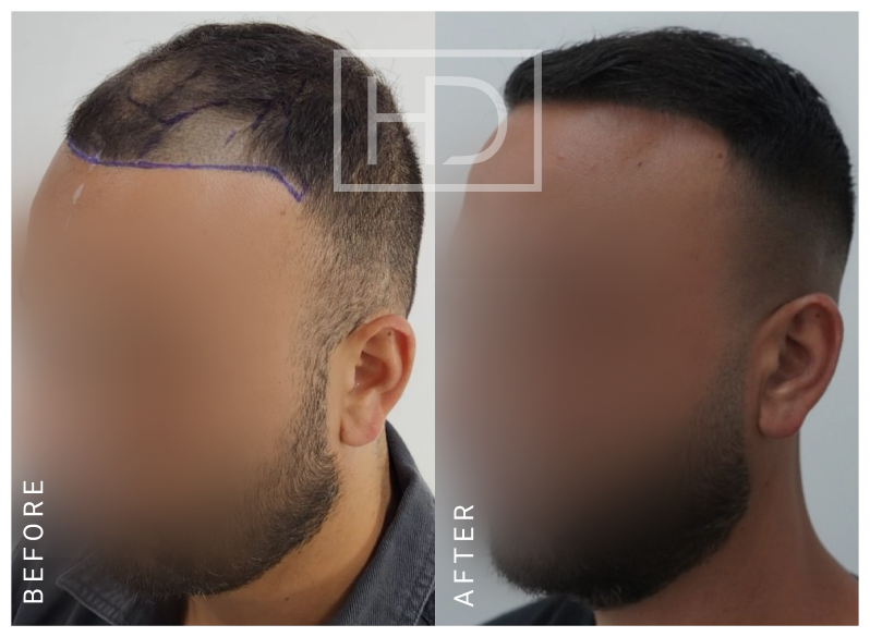 Doctor Hair Transplant
