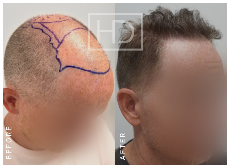 Doctor Hair Transplant