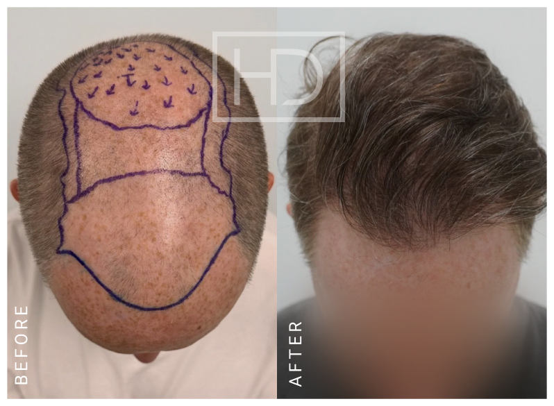 Doctor Hair Transplant