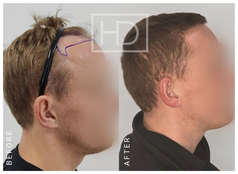 Doctor Hair Transplant