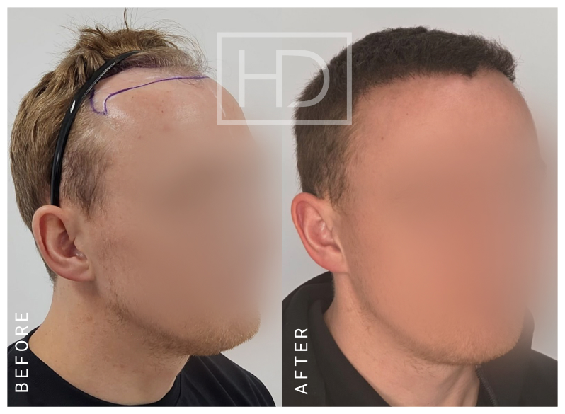 Doctor Hair Transplant