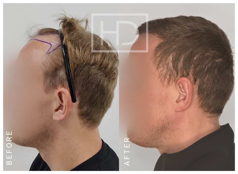 Doctor Hair Transplant