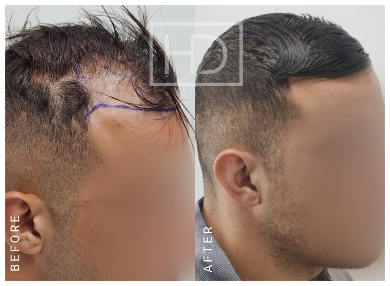 Doctor Hair Transplant