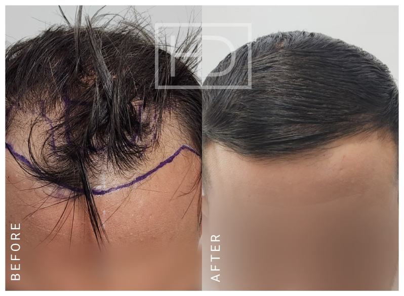 Doctor Hair Transplant