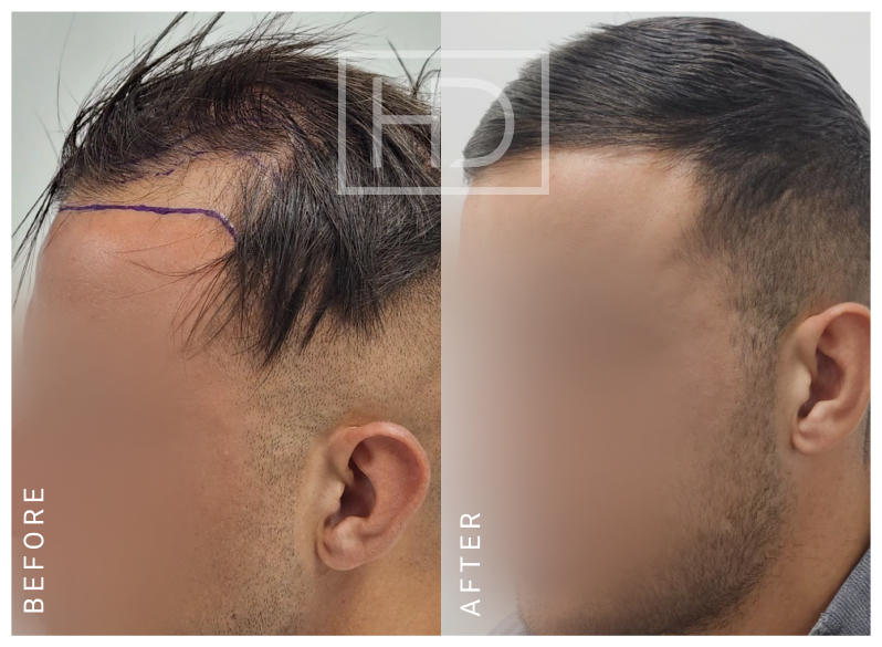 Doctor Hair Transplant