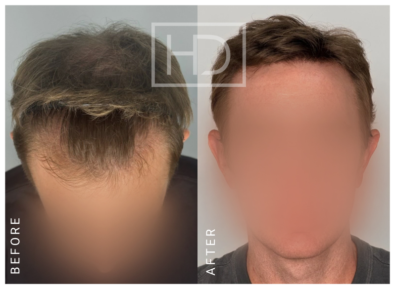 Doctor Hair Transplant