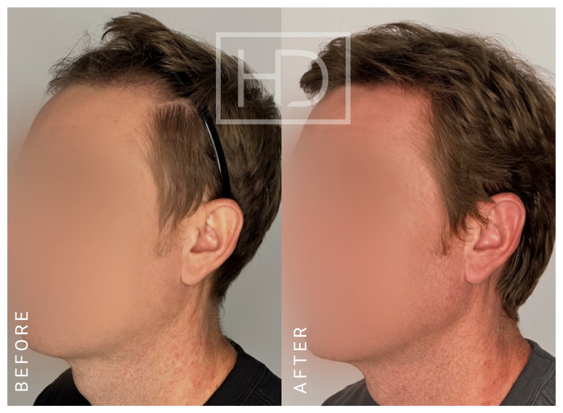 Doctor Hair Transplant