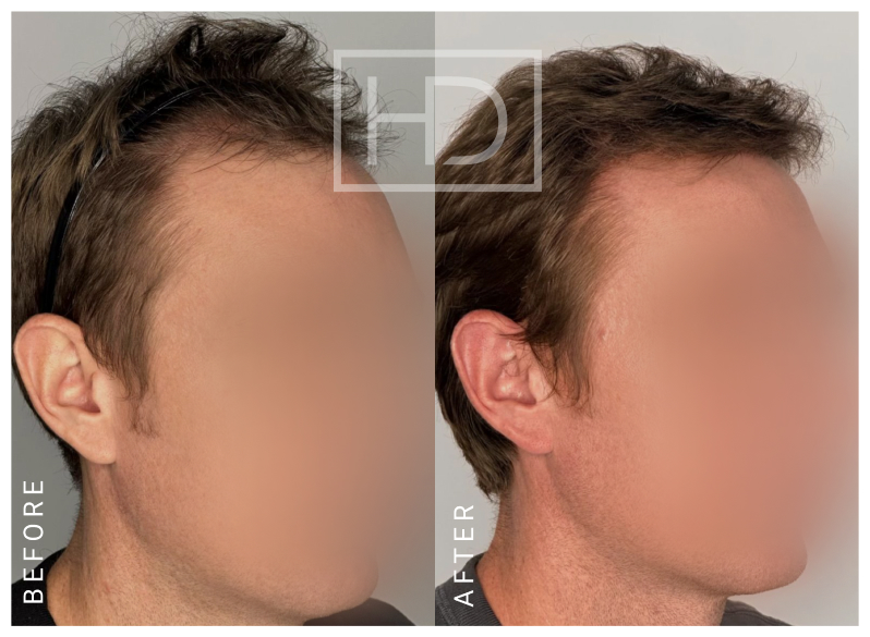 Doctor Hair Transplant