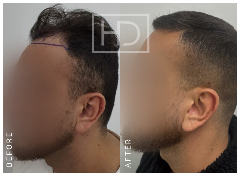 Doctor Hair Transplant