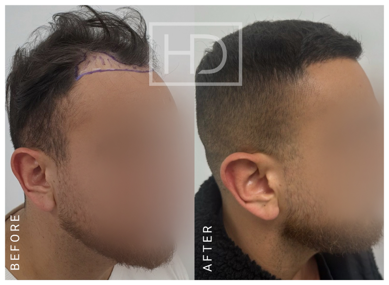 Doctor Hair Transplant