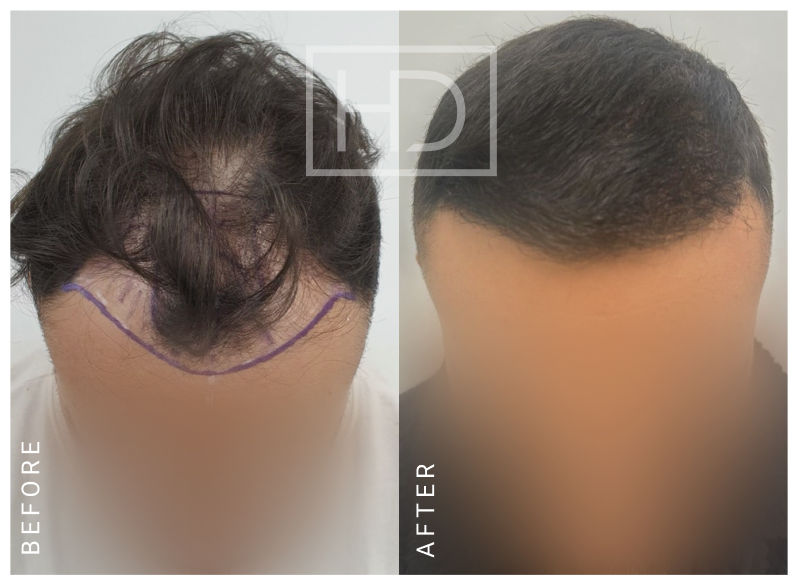 Doctor Hair Transplant