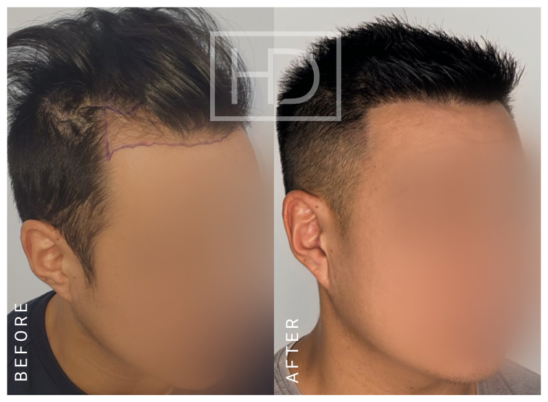 Doctor Hair Transplant