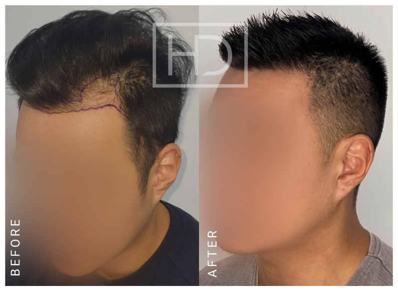 Doctor Hair Transplant