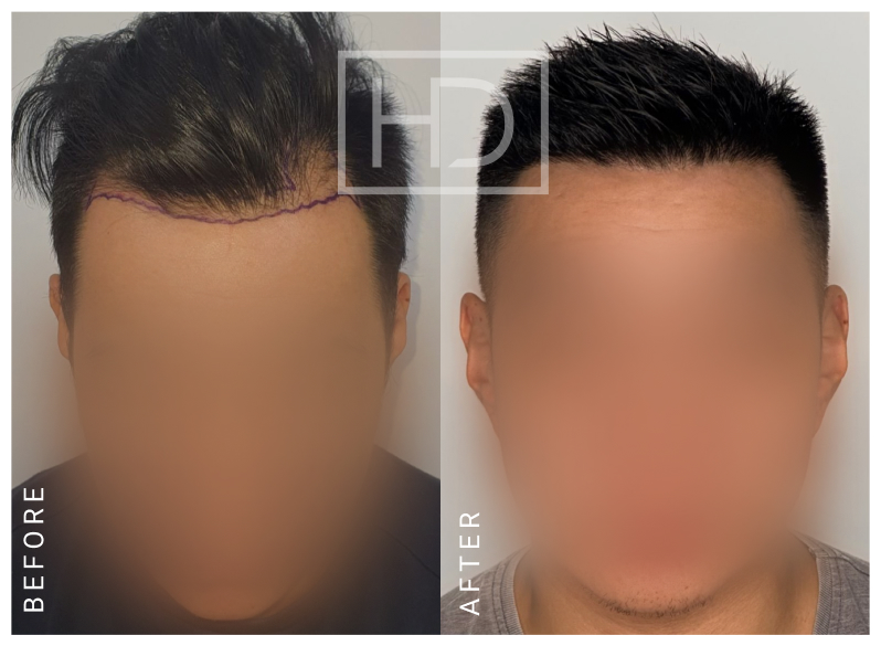 Doctor Hair Transplant