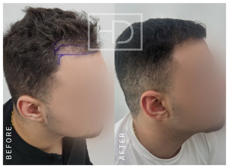 Doctor Hair Transplant