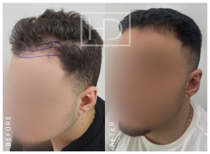 Doctor Hair Transplant