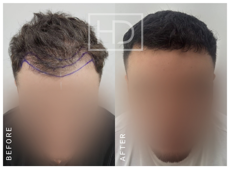 Doctor Hair Transplant