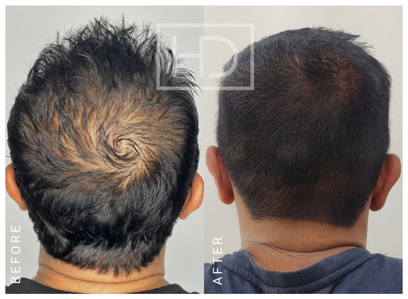 Doctor Hair Transplant