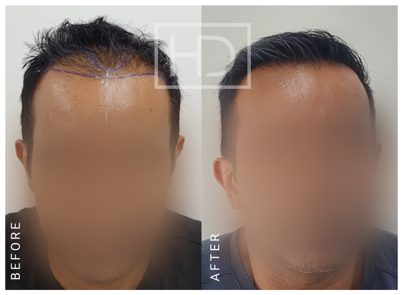 Doctor Hair Transplant