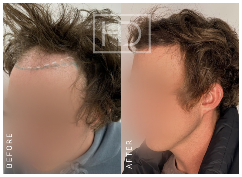 Doctor Hair Transplant