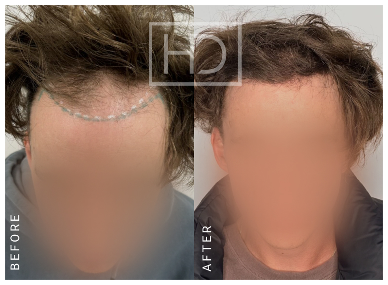 Doctor Hair Transplant