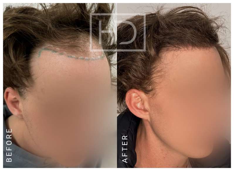 Doctor Hair Transplant