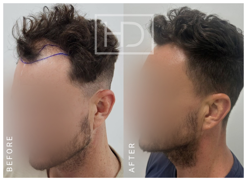 Doctor Hair Transplant