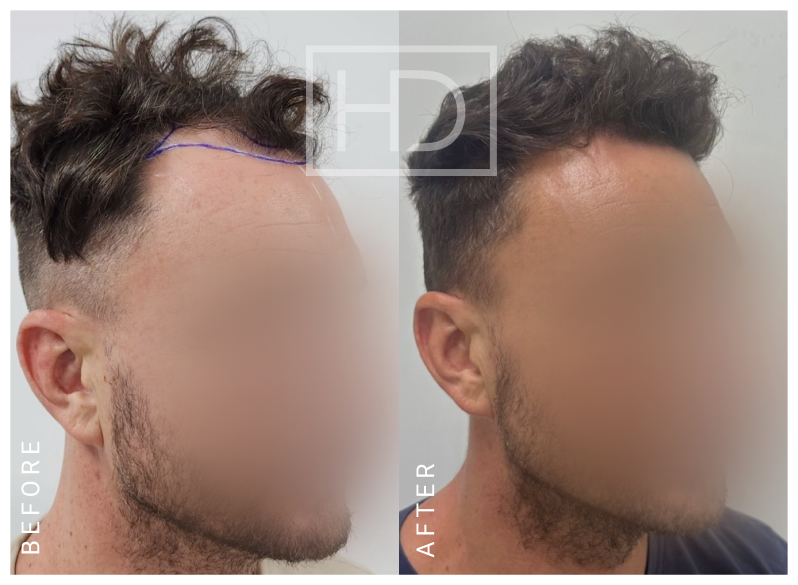 Doctor Hair Transplant