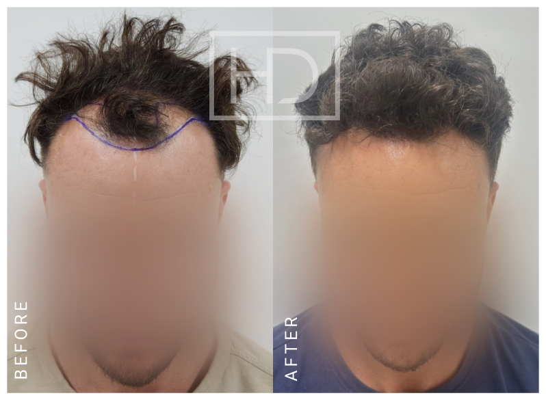 Doctor Hair Transplant