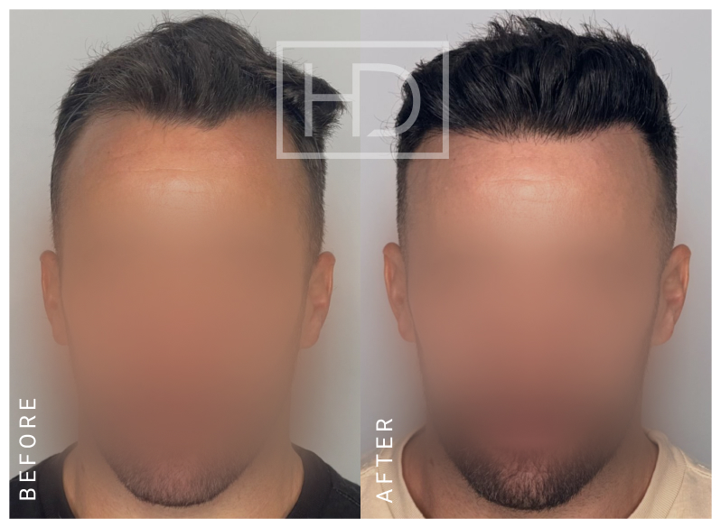 Doctor Hair Transplant