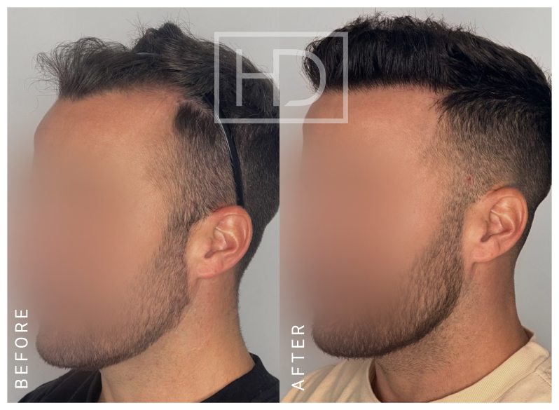 Doctor Hair Transplant