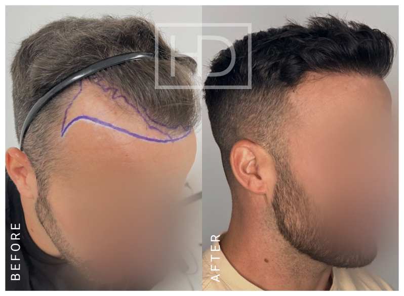 Doctor Hair Transplant