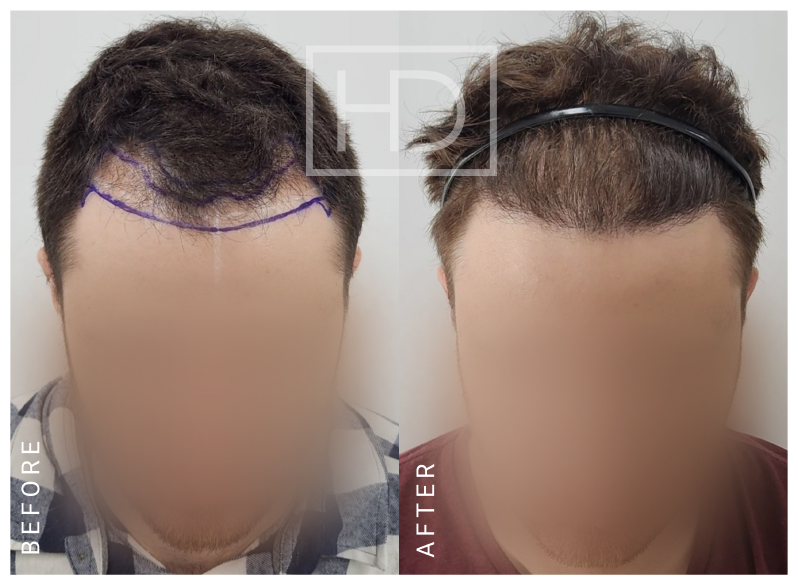 Doctor Hair Transplant