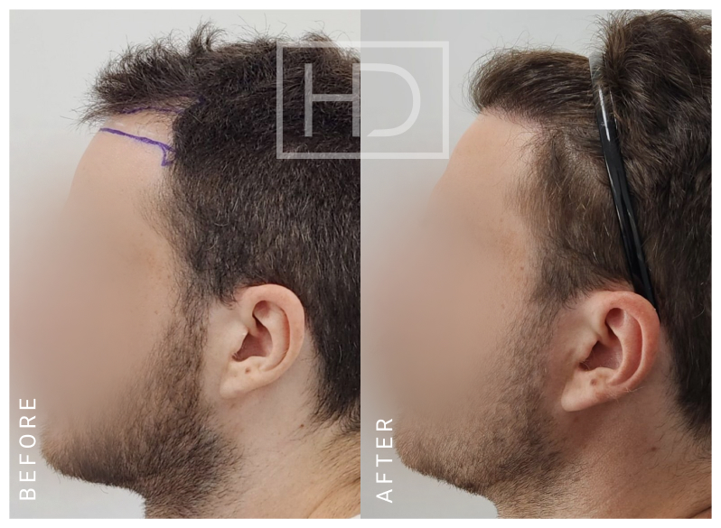 Doctor Hair Transplant
