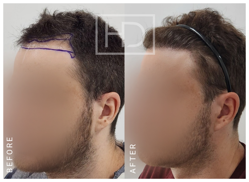 Doctor Hair Transplant