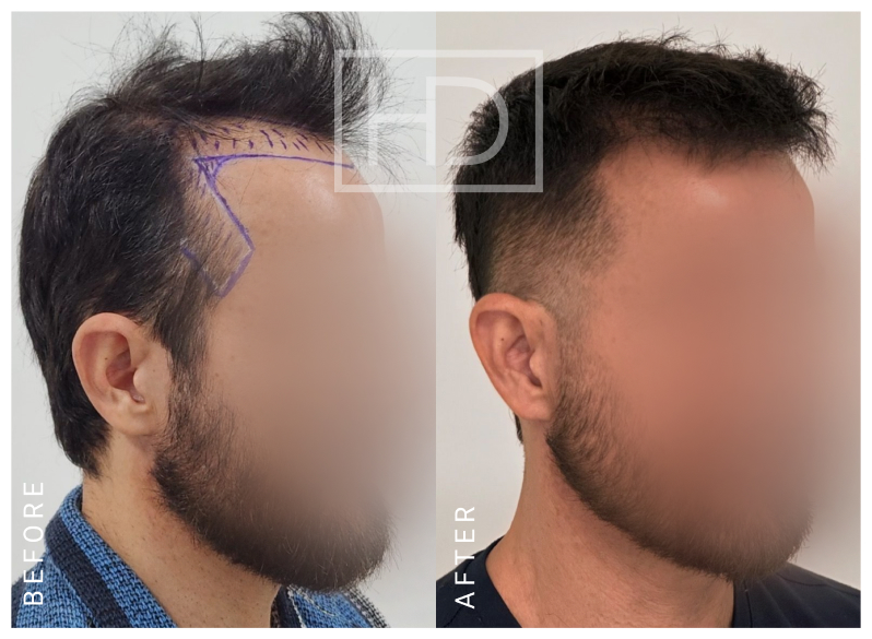 Doctor Hair Transplant