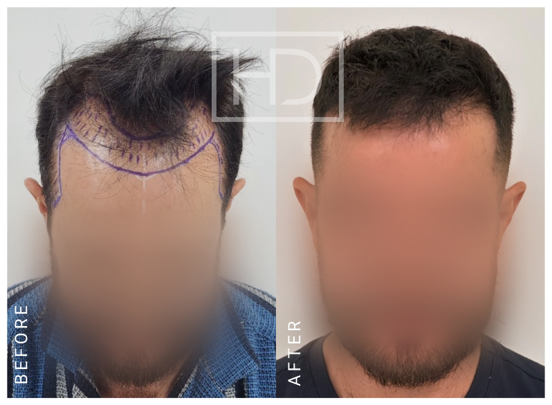 Doctor Hair Transplant