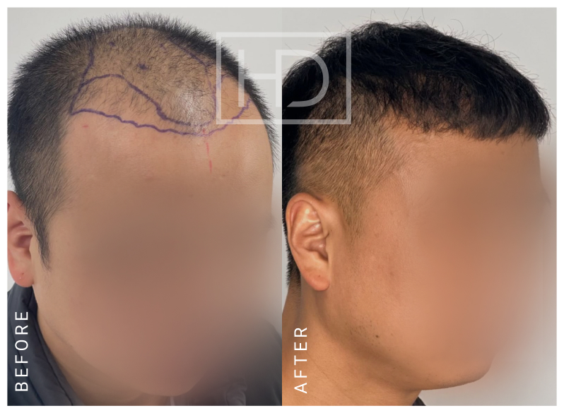 Doctor Hair Transplant